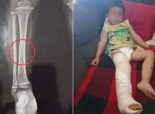 Briga por brinquedo em creche termina com menino com a perna quebrada