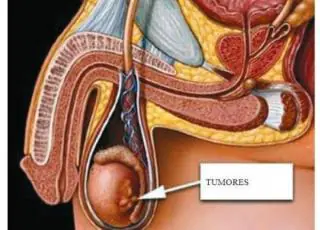 Câncer de testículo: Cinco dúvidas comuns que ninguém pergunta