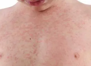 Casos de sarampo aumentam no mundo, alerta OMS