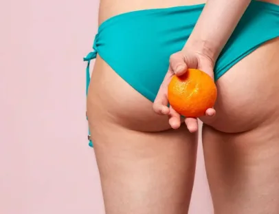 Celulite: conheça 5 mitos e verdades sobre os furinhos na pele  