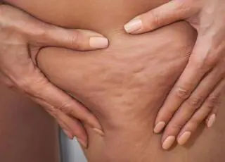 CINCO PASSOS PARA PREVENIR E TRATAR CELULITE