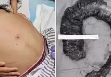 Cirurgiões removem 20 kg de cocô do intestino de mulher após 10 dias sem evacuar