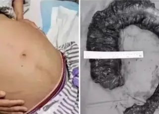 Cirurgiões removem 20 kg de cocô do intestino de mulher após 10 dias sem evacuar