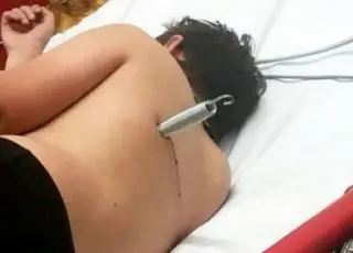 Defeito em cama elástica deixa adolescente com mola cravada nas costas