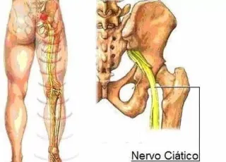 Dr. Leonardo esclarece sobre uma das lesões mais comuns da coluna lombar (Ciatalgia), ou seja, dor no nervo ciático