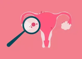 Endometriose: conheça as causas, os sintomas e os tratamentos