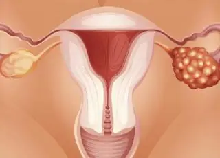 Endometriose, o que é? Sintomas, consequências, tratamento, prevenção