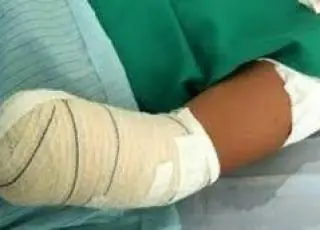 Filho de dono de restaurante decepa mão de funcionária em Nanuque