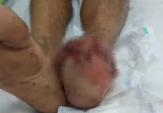 Homem fica gravemente ferido após pisar em artefato explosivo durante brincadeira em Rondônia