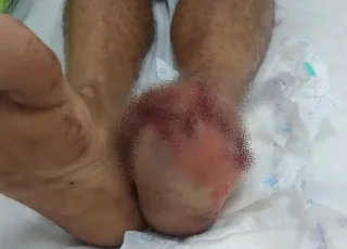 Homem fica gravemente ferido após pisar em artefato explosivo durante brincadeira em Rondônia