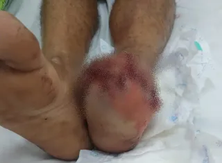 Homem fica gravemente ferido após pisar em artefato explosivo durante brincadeira em Rondônia