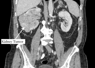 Homem vai tratar dor no dedão do pé e descobre tumor em fase terminal