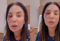 Ivete Sangalo comenta cirurgia no rosto após queda no banheiro: 'Quebrei dois ossos'  