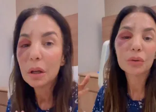 Ivete Sangalo comenta cirurgia no rosto após queda no banheiro: 'Quebrei dois ossos'  