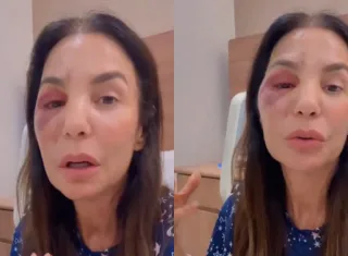 Ivete Sangalo comenta cirurgia no rosto após queda no banheiro: 'Quebrei dois ossos'  