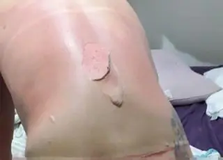 Jovem com o corpo em chamas é socorrida por moradores no Espírito Santo