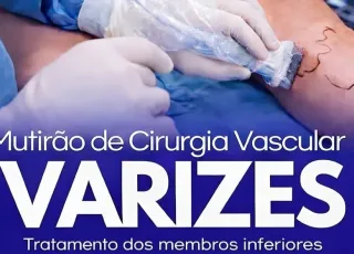 Lajedão promove mutirão de cirurgia vascular com consultas e procedimentos para tratamento de varizes