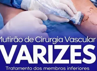 Lajedão promove mutirão de cirurgia vascular com consultas e procedimentos para tratamento de varizes