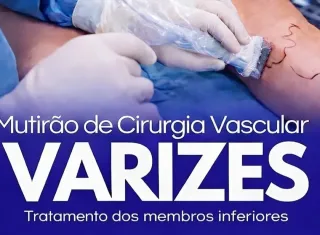 Lajedão realiza mutirão de cirurgias para tratamento de varizes