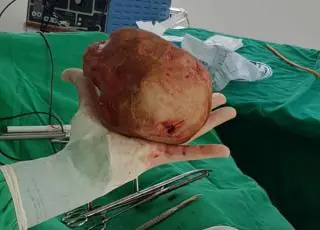 Lavrador de 51 anos tem pedra de 1,3 Kg e 18 cm retirada da bexiga em cirurgia na Bahia