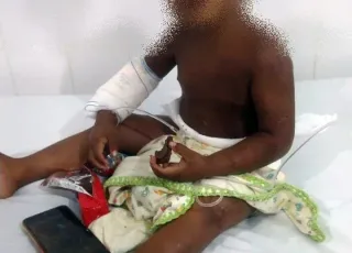 Bebê de  2 anos e espancado, queimado com bituca de cigarro  pela mãe e abandonado na praia na cidade de Alcobaça. Criança teve costela e pênis quebrados