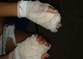 Mãe é presa por queimar as mãos do filho com uma frigideira quente