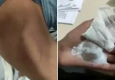 Mãe é suspeita de queimar mão do filho de 12 anos após ele pegar moedas para comprar doce
