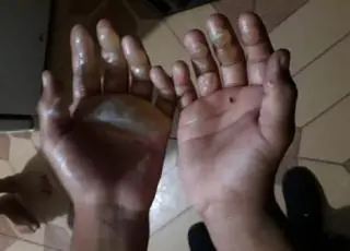 Mãe queima as mãos do filho de 09 anos com ferro de passar