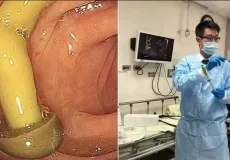 Médico encontra cogumelo crescendo em intestino de paciente; entenda