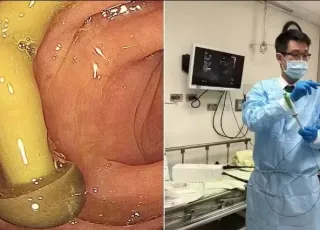 Médico encontra cogumelo crescendo em intestino de paciente; entenda
