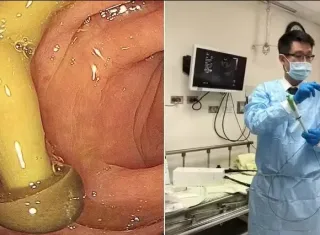 Médico encontra cogumelo crescendo em intestino de paciente; entenda