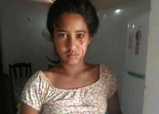 Menina de 12 anos sangra pelos olhos e família busca pelo diagnóstico no Piauí