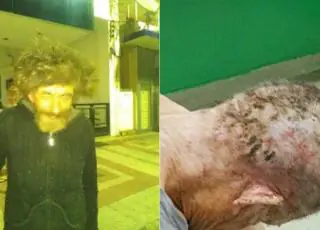 Morador de rua é encontrado com 92 larvas no couro cabeludo