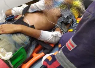 Motociclista tem fratura exposta ao ser atingido por caminhonete