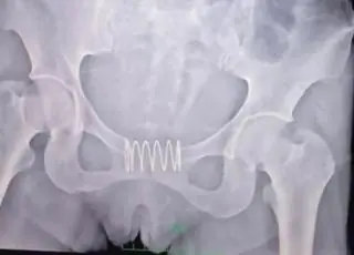 Mulher é operada após colocar mola de metal na vagina para não engravidar