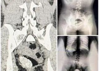 Mulher é presa após ser flagrada por Body Scan ao tentar entrar com drogas em unidade prisional na Bahia