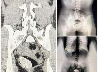 Mulher é presa após Body Scan apontar material ilícito em unidade prisional da Bahia