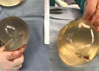 Mulher leva tiro e sobrevive graças a implante de silicone nos seios