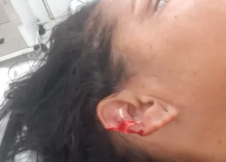Mulher tem pedaço da orelha arrancada pelo marido durante ataque de fúria