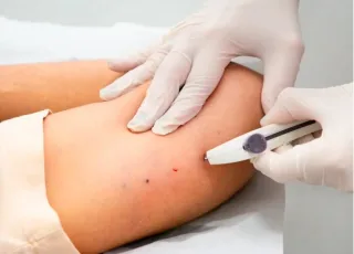 Mulheres de Itanhém passam a contar com Implanon na rede pública de saúde