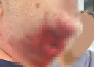 Paciente surta, arranca pedaço de rosto de médico com mordida e quebra portas de hospital