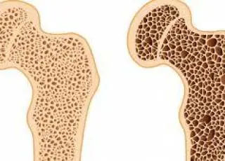 Permanecer sem fraturas é essencial para pacientes com osteoporose durante a pandemia