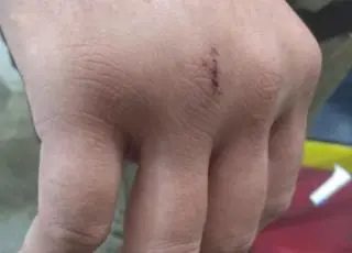 PM teve mão fraturada em Teixeira de Freitas em ação que preso tentou tomar sua arma