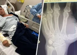 Popó passa por cirurgia após sangramento interno e fratura na mão durante briga generalizada com Wanderlei Silva 