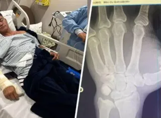 Popó passa por cirurgia após sangramento interno e fratura na mão durante briga generalizada com Wanderlei Silva 