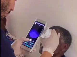 Prefeitura de Ibirapuã intensifica atendimento ao Glaucoma e reforça compromisso com a saúde ocular da população