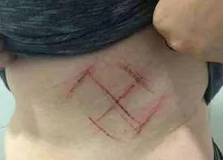 Suástica em corpo de jovem foi 