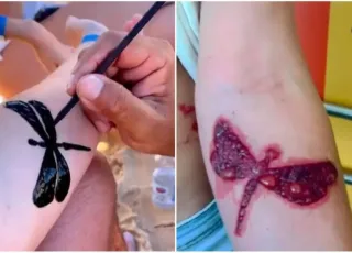 Tatuagem de henna é comum no verão, mas oferece riscos à pele  