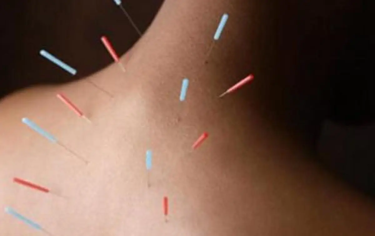 Terapias Alternativas: Acupuntura como aliada no tratamento da ...