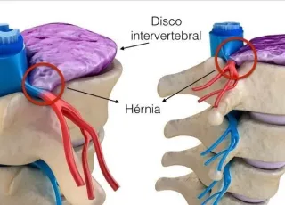 Vamos Falar Sobre hérnia de disco .. Dr Leonardo Felipe explica como aliviar os sintomas